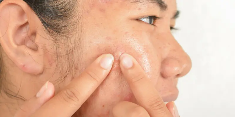 Tea Tree Oil For Acne